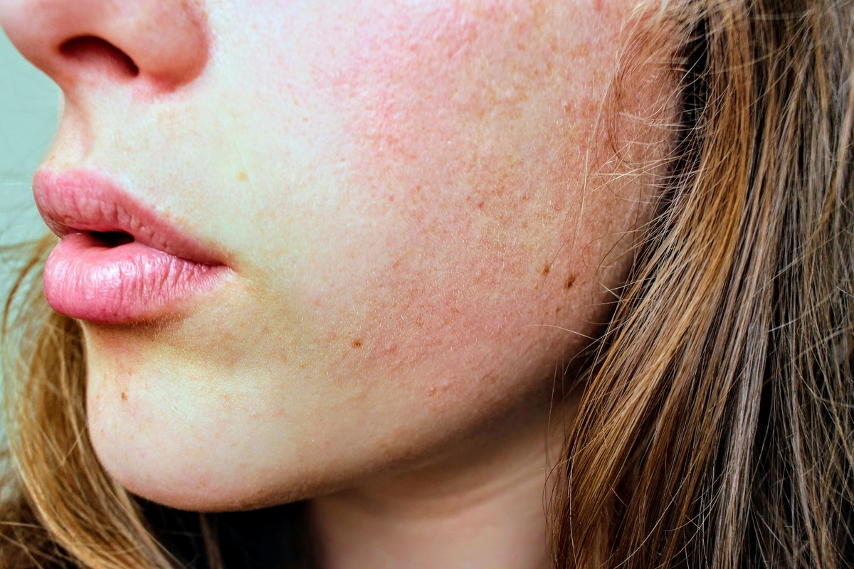 7 Reasons Why The Skin On Your Face Is Always Red
